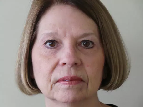 Eyelid Surgery Patient 10 After 1