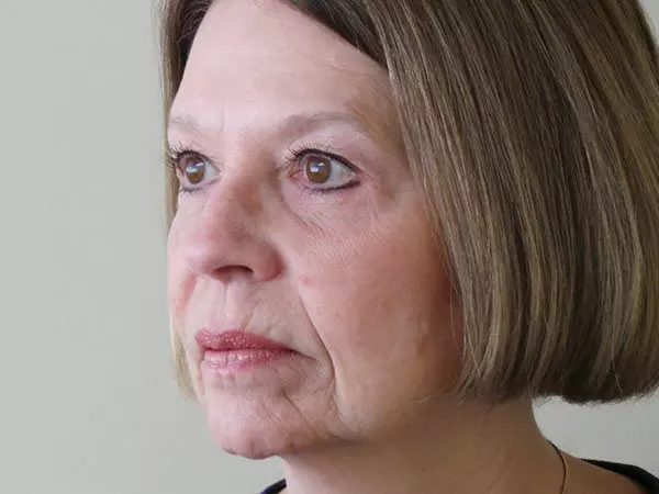 Eyelid Surgery Patient 10 After 2