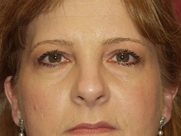 Eyelid Surgery Patient 12 Before 1