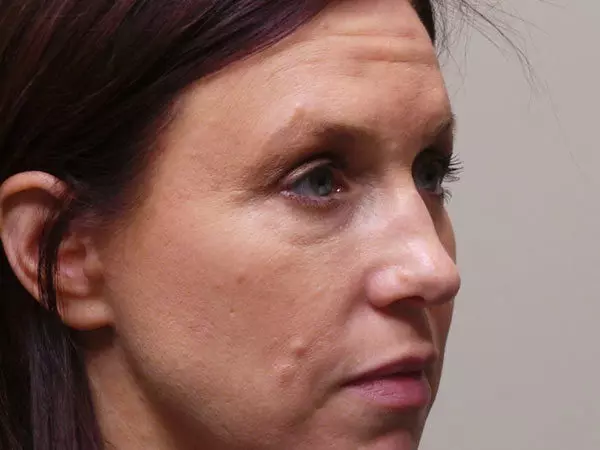 Eyelid Surgery Patient 13 After 2