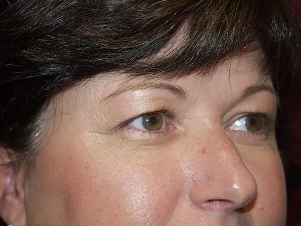 Eyelid Surgery Patient 15 Before 2