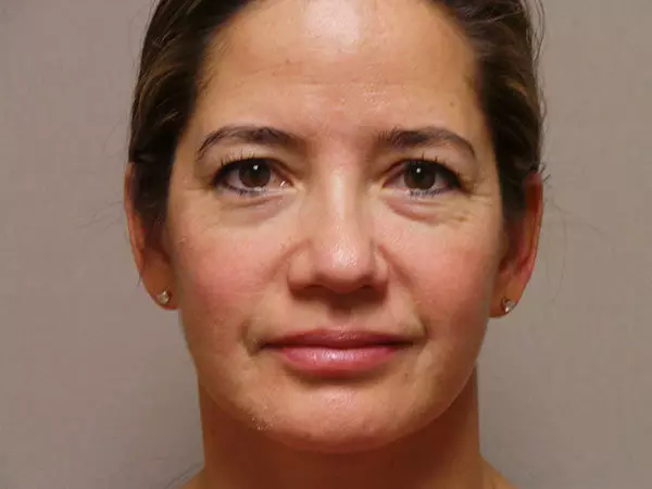 Eyelid Surgery Patient 16 Before 1