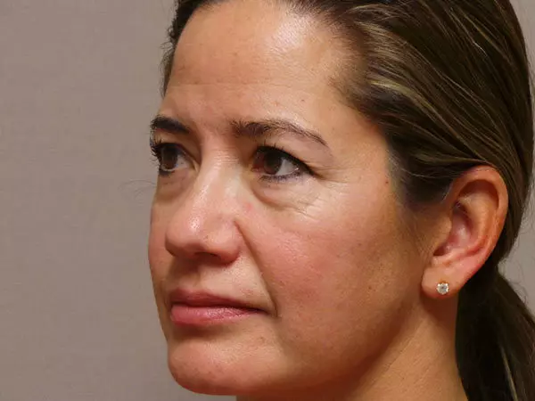 Eyelid Surgery Patient 16 Before 2