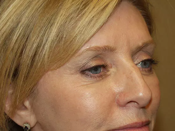 Eyelid Surgery Patient 21 After 2