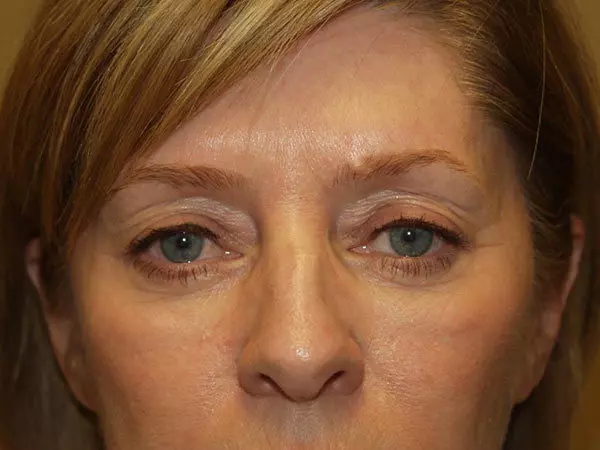 Eyelid Surgery Patient 21 Before 1