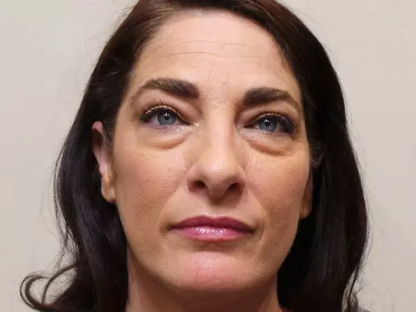 Eyelid Surgery Patient 11 Before 1