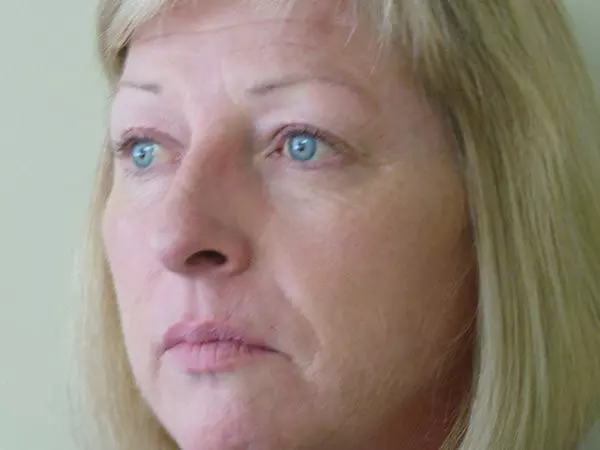 Eyelid Surgery Patient 17 Before 1