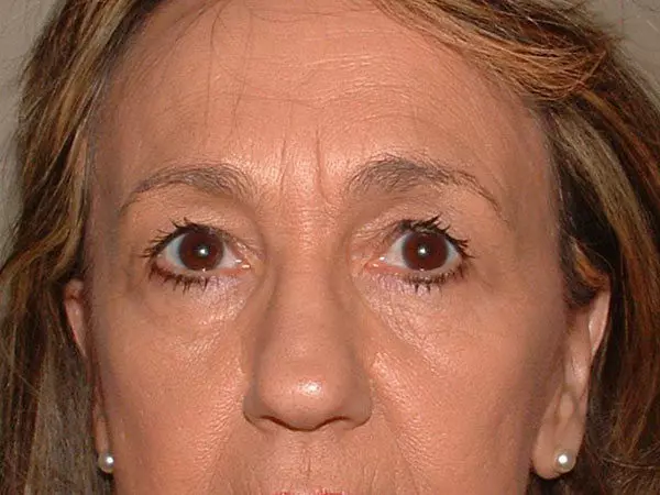 Eyelid Surgery Patient 19 Before 1