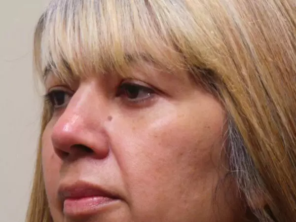 Eyelid Surgery Patient 03 After 1