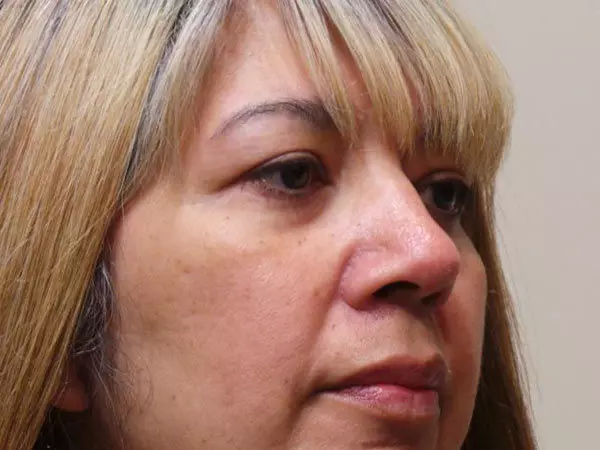 Eyelid Surgery Patient 03 After 2