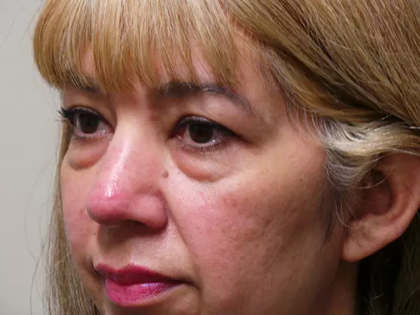 Eyelid Surgery Patient 03 Before 1