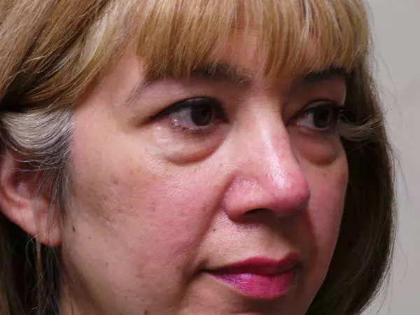 Eyelid Surgery Patient 03 Before 2