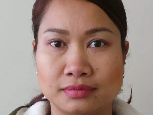 Eyelid Surgery Patient 04 After 1