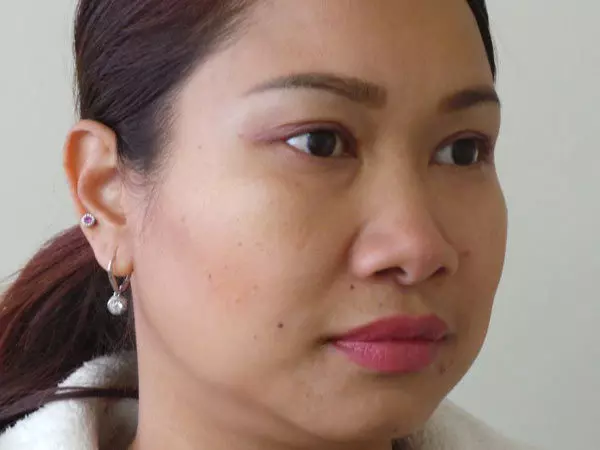 Eyelid Surgery Patient 04 After 2