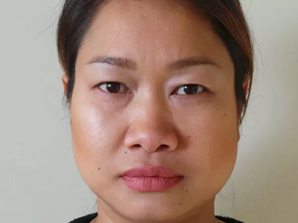 Eyelid Surgery Patient 04 Before 1