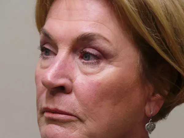 Eyelid Surgery Patient 05 After 1