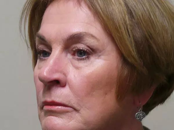 Eyelid Surgery Patient 05 Before 1