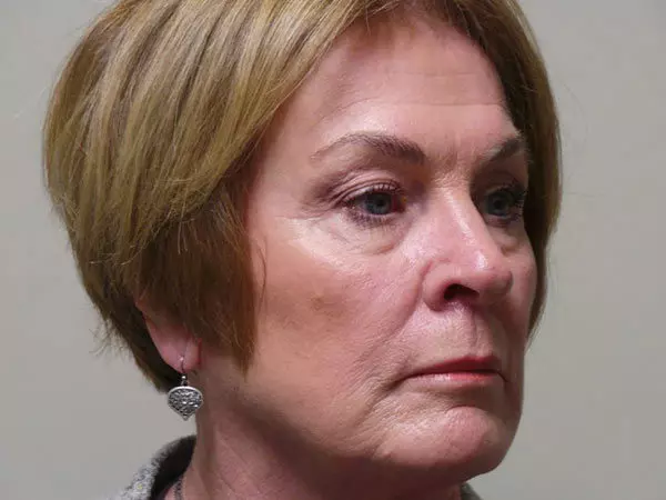 Eyelid Surgery Patient 05 Before 2