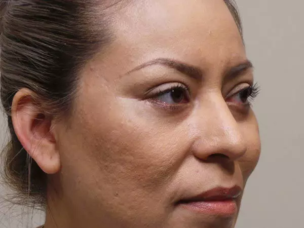 Eyelid Surgery Patient 06 After 1