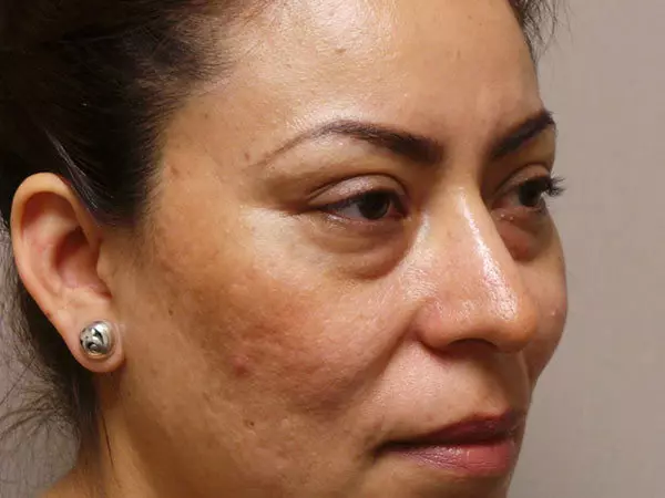 Eyelid Surgery Patient 06 Before 1