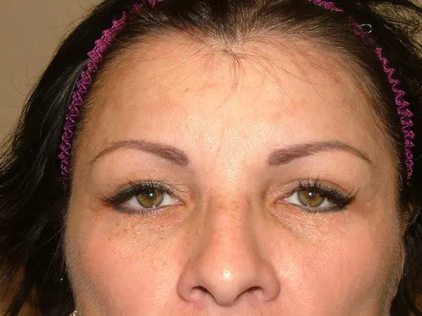 Eyelid Surgery Patient 07 After 2