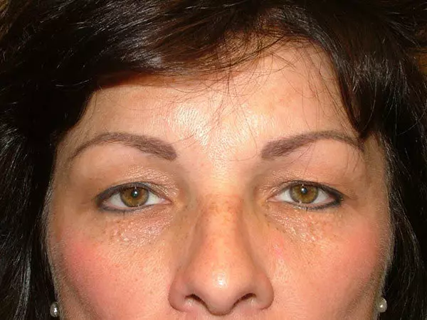 Eyelid Surgery Patient 07 Before 2