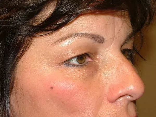 Eyelid Surgery Patient 07 Before 1