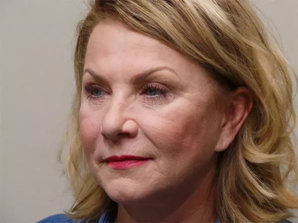 Eyelid Surgery Patient 08 After 2