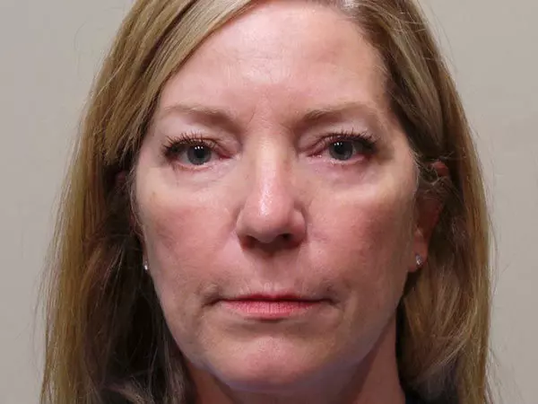 Eyelid Surgery Patient 09 After 1