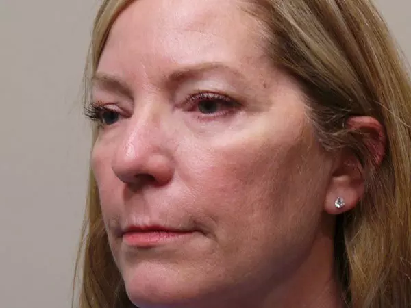 Eyelid Surgery Patient 09 After 2