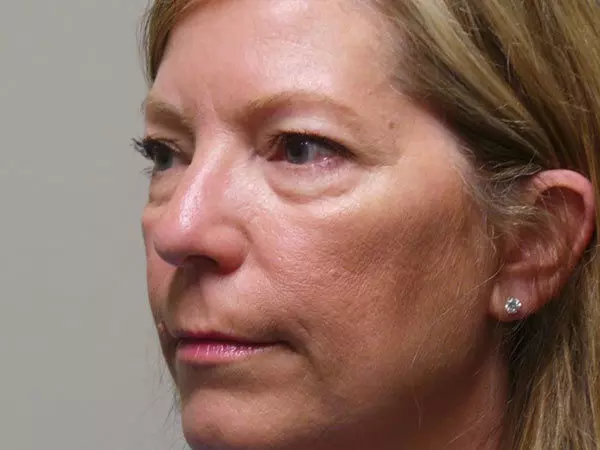 Eyelid Surgery Patient 09 Before 2