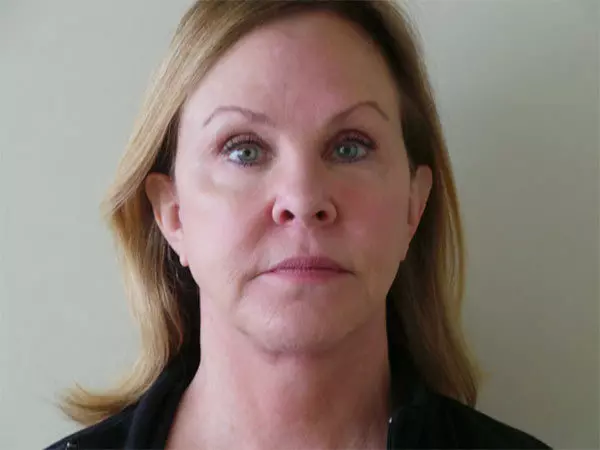 FaceLift Patient 01 After 1