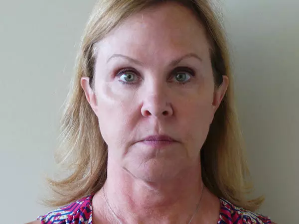 FaceLift Patient 01 Before 1