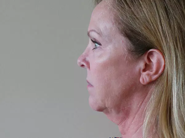 FaceLift Patient 01 Before 2