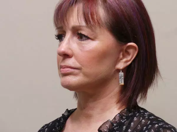 FaceLift Patient 02 After 1