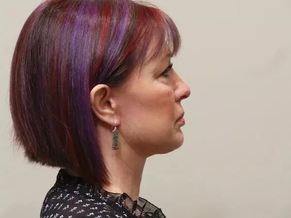 FaceLift Patient 02 After 2