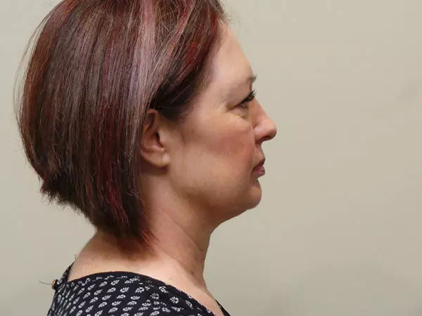 FaceLift Patient 02 Before 2