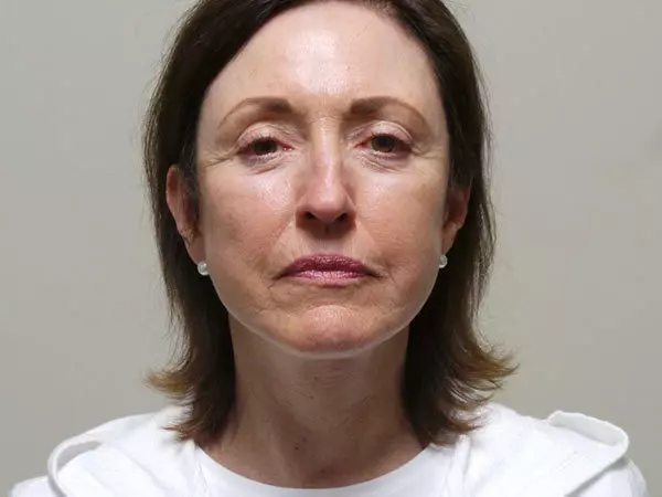 Facelift Patient 03 After 1