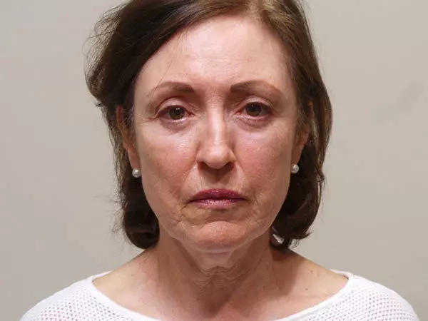 Facelift Patient 03 Before 1