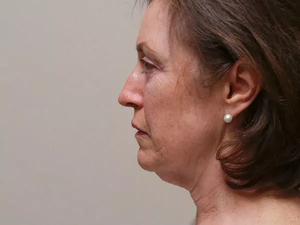 Facelift Patient 03 Before 2