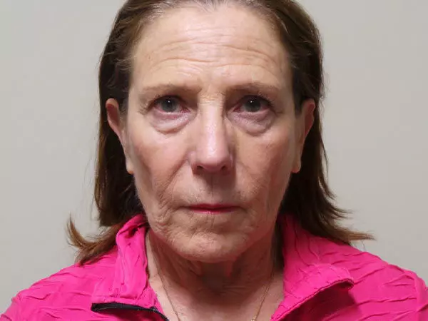 Facelift Patient 08 Before 1