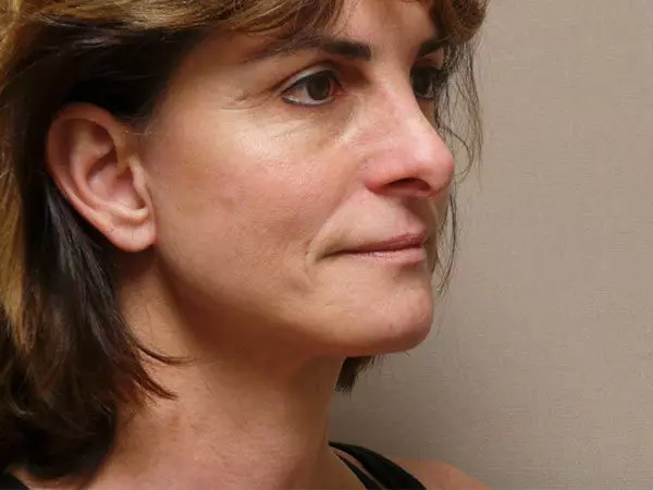 Facelift Patient 09 After 2