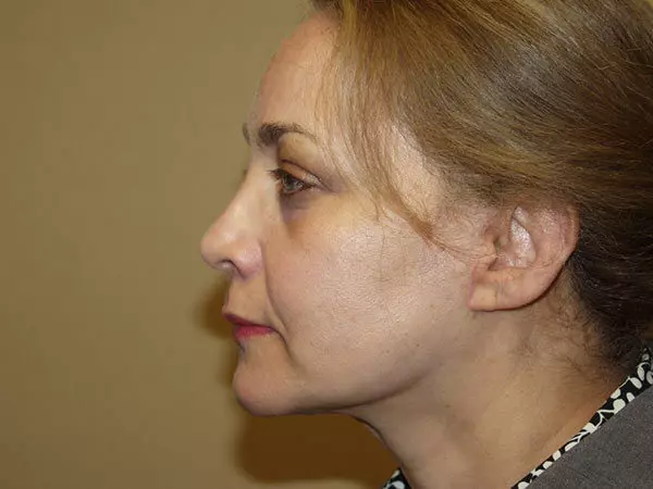 Facelift Patient 10 After 1