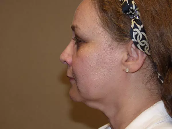 Facelift Patient 10 Before 1