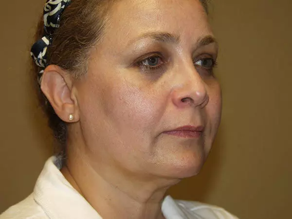 Facelift Patient 10 Before 2