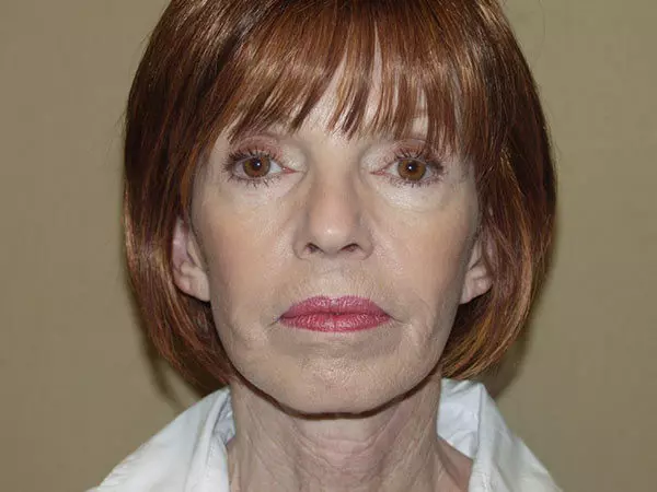 Facelift Patient 11 After 1