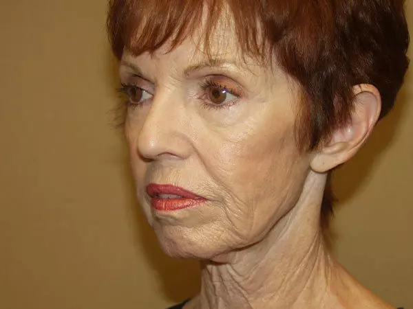 Facelift Patient 11 Before 2