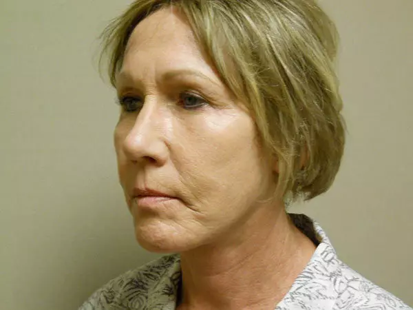 Facelift Patient 12 After 2