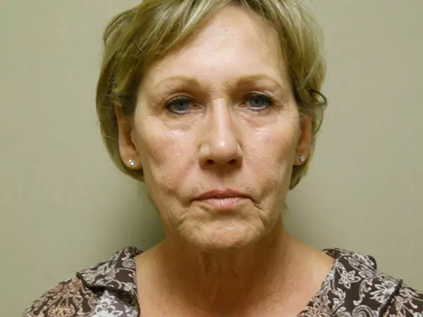 Facelift Patient 12 Before 1