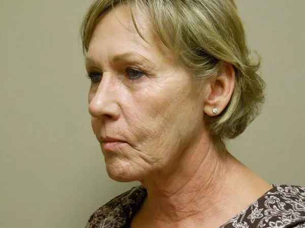 Facelift Patient 12 Before 2